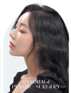 Bedah Plastik Hidung