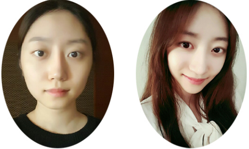 JJung’s Plastic Surgery Real Review