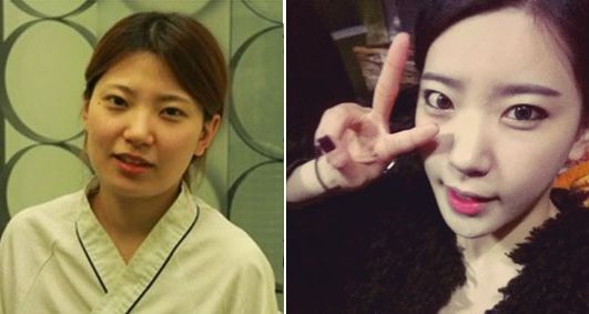 Heedong’s Plastic Surgery Real Review