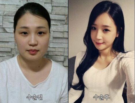 Binny’s Plastic Surgery Real Review