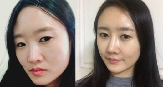 Ms.C’s Profile Surgery Real Review