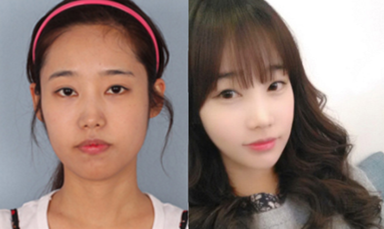 Choco’s Plastic Surgery Real Review