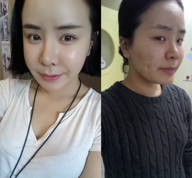 Dahee’s Plastic Surgery Real Review