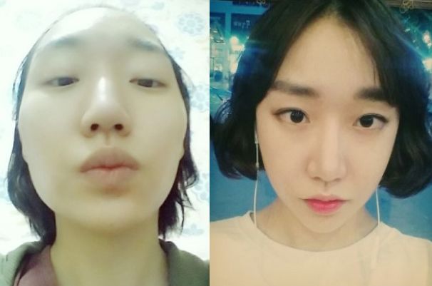 DongDong’s Plastic Surgery Real Review