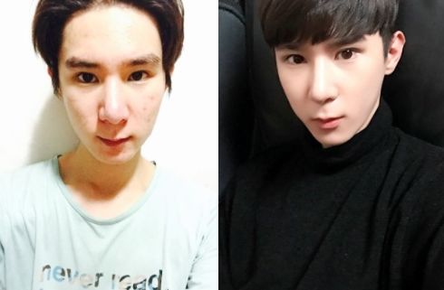 Hoyung’s Plastic Surgery Real Review