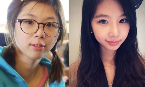 Hyunhee’s Plastic Surgery Real Review