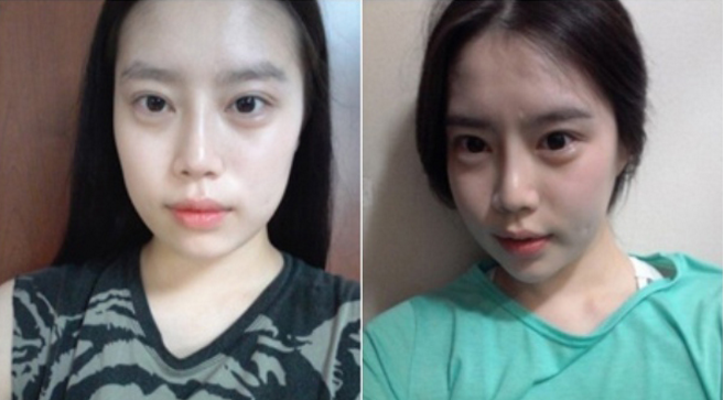 Hyeri’s Plastic Surgery Real Review