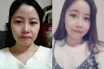 Meuw’s Plastic Surgery Real Review