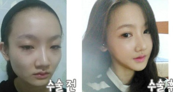 Minji’s Plastic Surgery Real Review