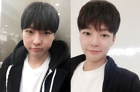 Minwoo’s Plastic Surgery Real Review