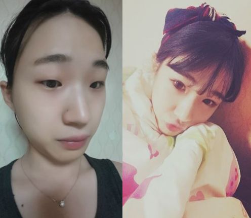 Narae’s Plastic Surgery Real Review