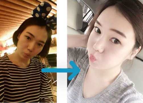 Sooah’s Plastic Surgery Real Review