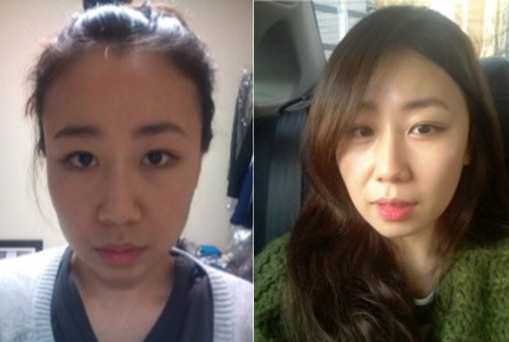 Potter’s Hair Transplant Surgery Real Review