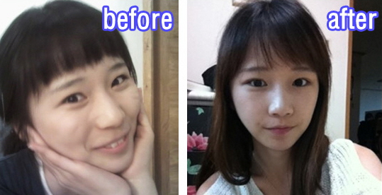 Chorong’s Plastic Surgery Real Revi