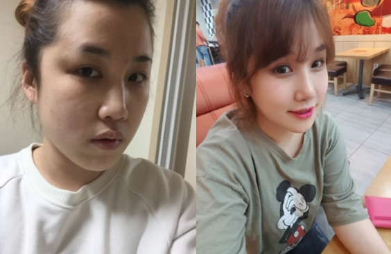 Jinkyung’s Plastic Surgery Real Review