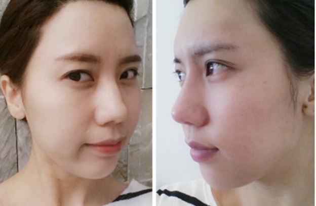 Seongmi’s Plastic Surgery Real Review