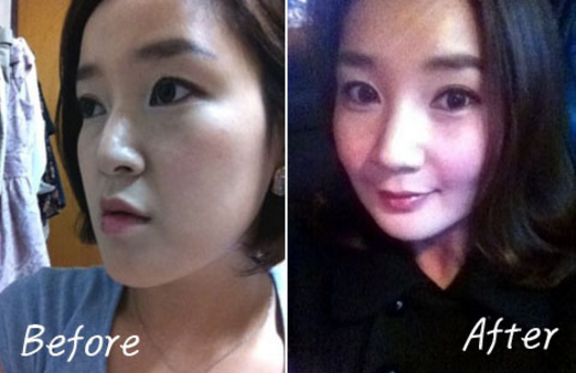 Berry Berry’s Plastic Surgery Real Review