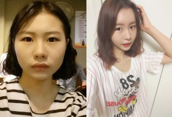 Yungji’s Plastic Surgery Real Review