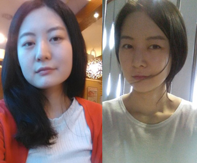 Yeoni’s Plastic Surgery Real Review