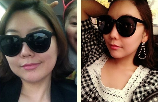 Artecoll Filler Injection Real Review