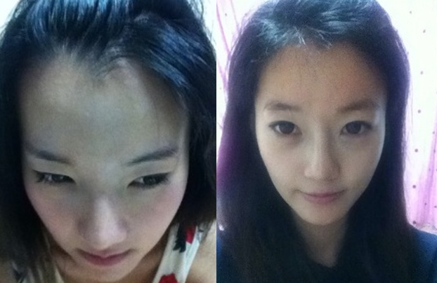 Bombom’s Plastic Surgery Real Review