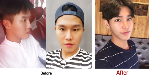 Crong’s Plastic Surgery Real Review