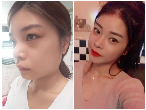 Pyupyuri’s Plastic Surgery Real Review