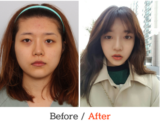 Hyoni’s Plastic Surgery Real Review
