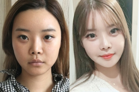 Yepoong-ee’s Plastic Surgery Real Review