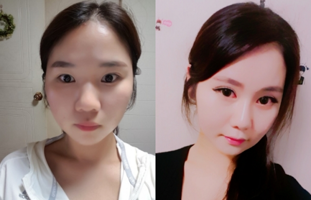 Heeya’s Plastic Surgery Real Review