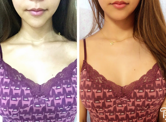 Chrissy’s Breast Augmentation Real Review