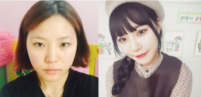 Yejin’s Plastic Surgery Real Review