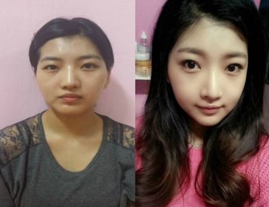 Hyejung’s Plastic Surgery Real Review