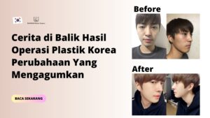 Cerita di Balik Hasil Operasi Plastik Korea Perubahaan Yang Mengagumkan