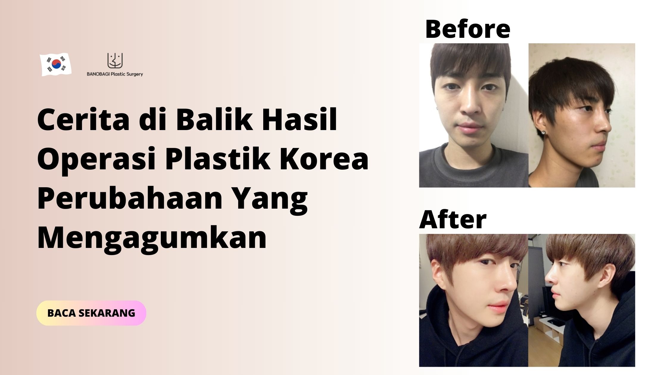 Hasil Operasi Plastik Korea