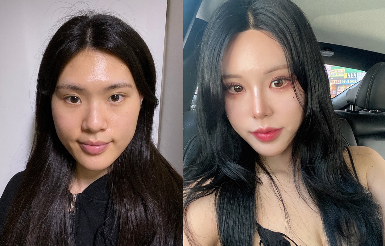 Cerita Operasi Hidung dan Fat Graft dari Somi