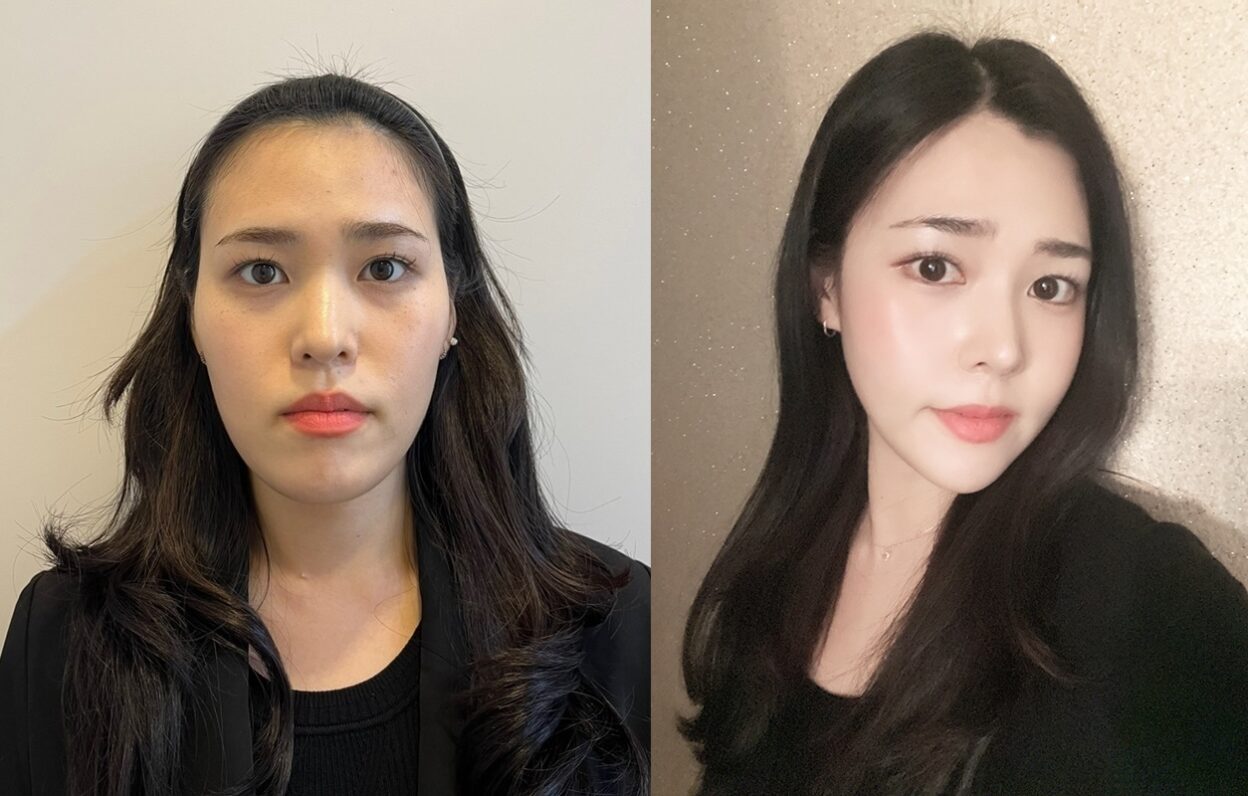 Bye-bye Wajah Seperti Kacang dan Hidung Pendek!