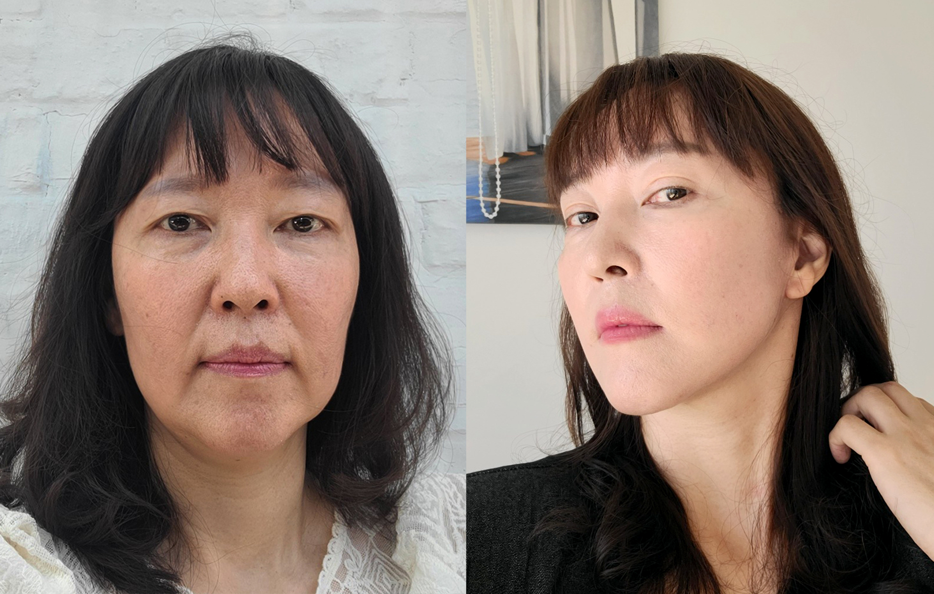 10 Tahun Lebih Muda Dengan Face Lifting + Upper Blepharoplasty