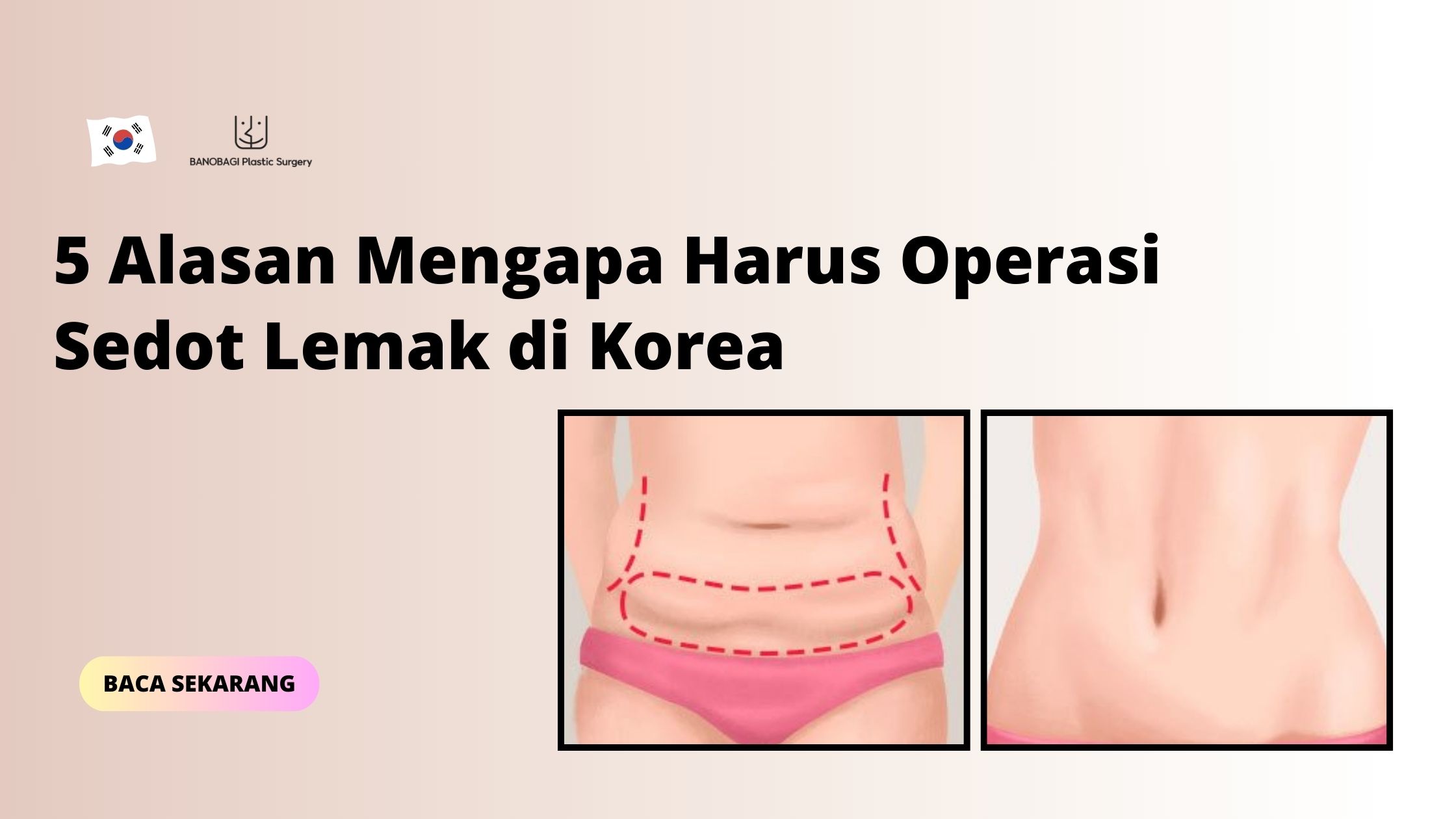 operasi sedot lemak di korea