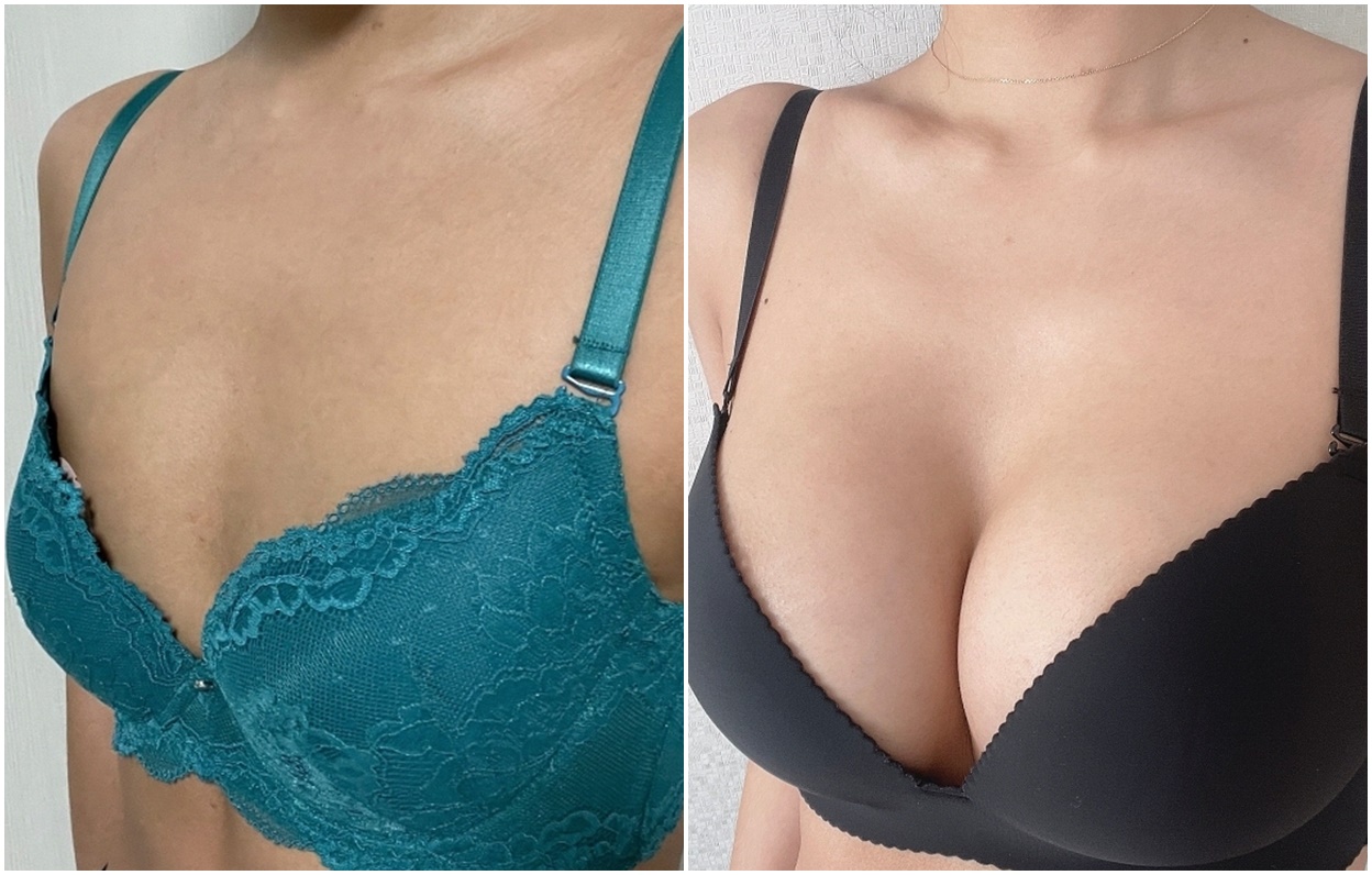 Cerita Setelah Implan Payudara: Dari Cup A, Jadi Cup E!