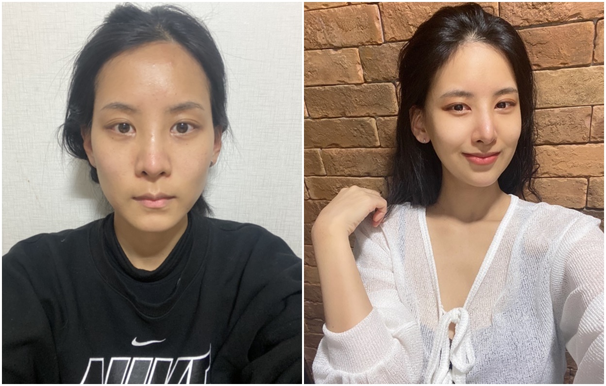 Review Hasil Rhinoplasty dan Kontur Wajah Sekaligus!