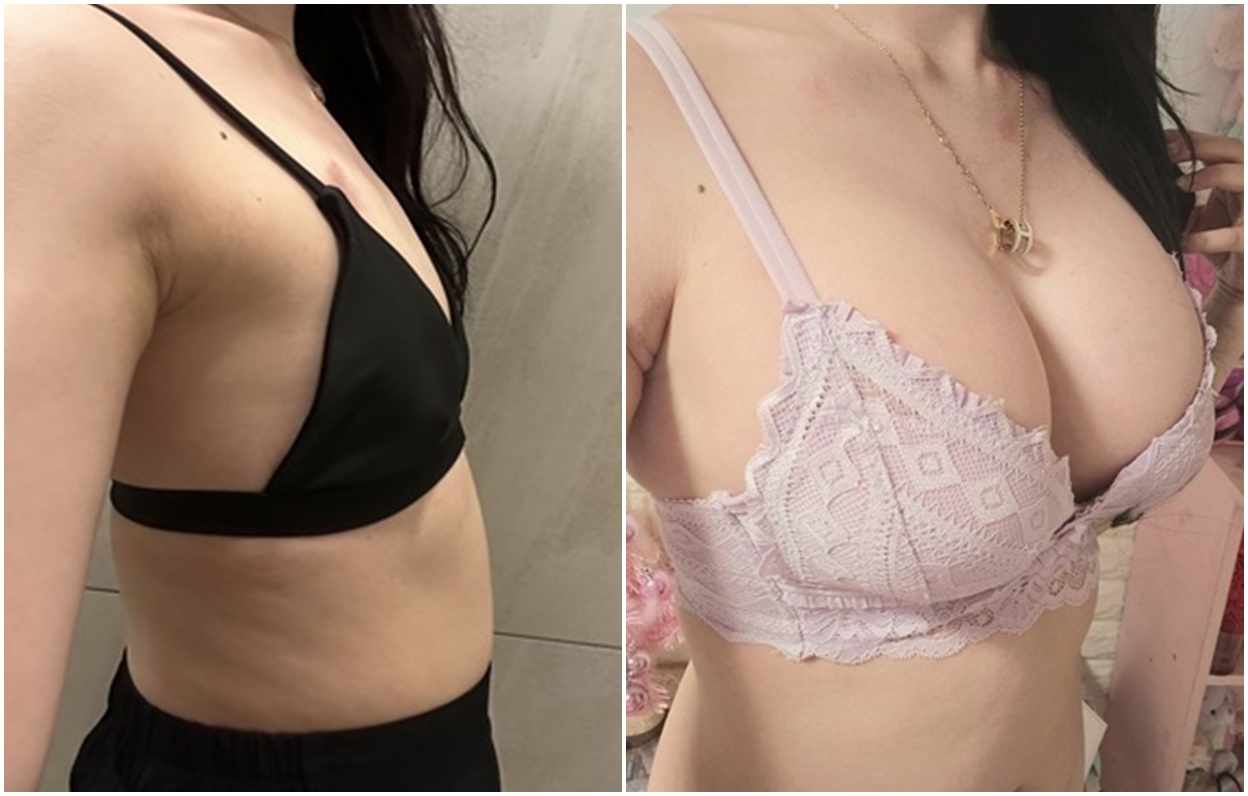 Review Prosedur Breast Augmentation di BANOBAGI