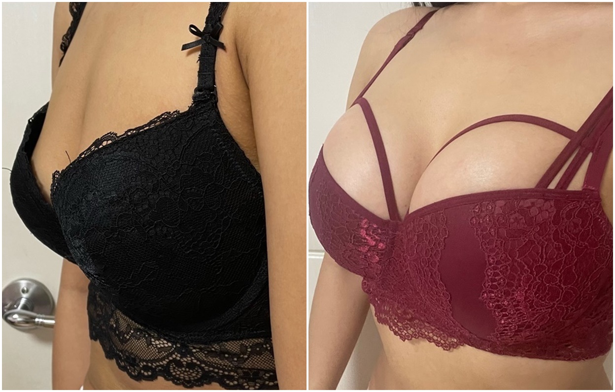 Payudara Bervolume! Breast Augmentation dengan Motiva