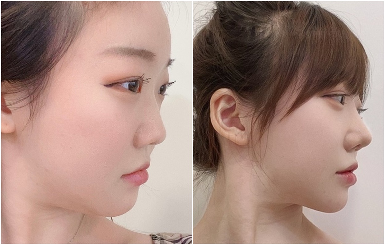 Diary Choco, Berhasil Dapat Hidung Impian!