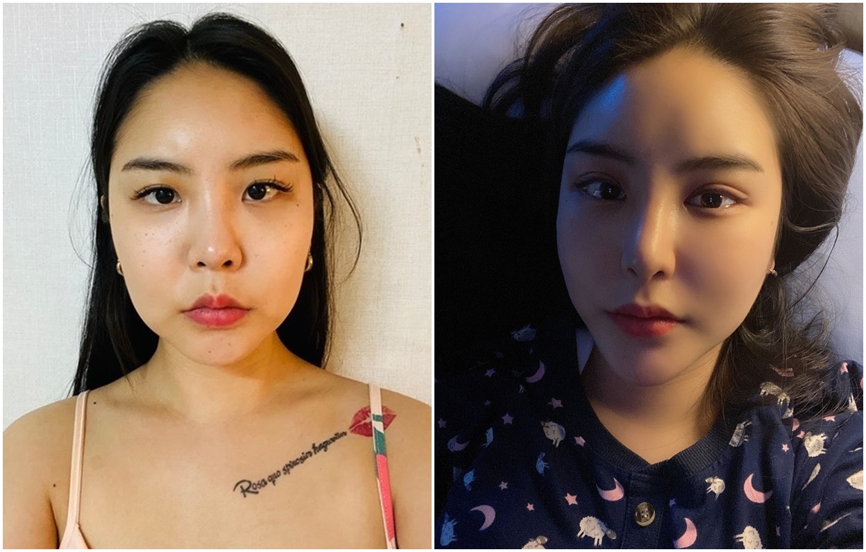 Magic! Wajah Lebih Proporsional Dengan Operasi Mata dan Rhinoplasty