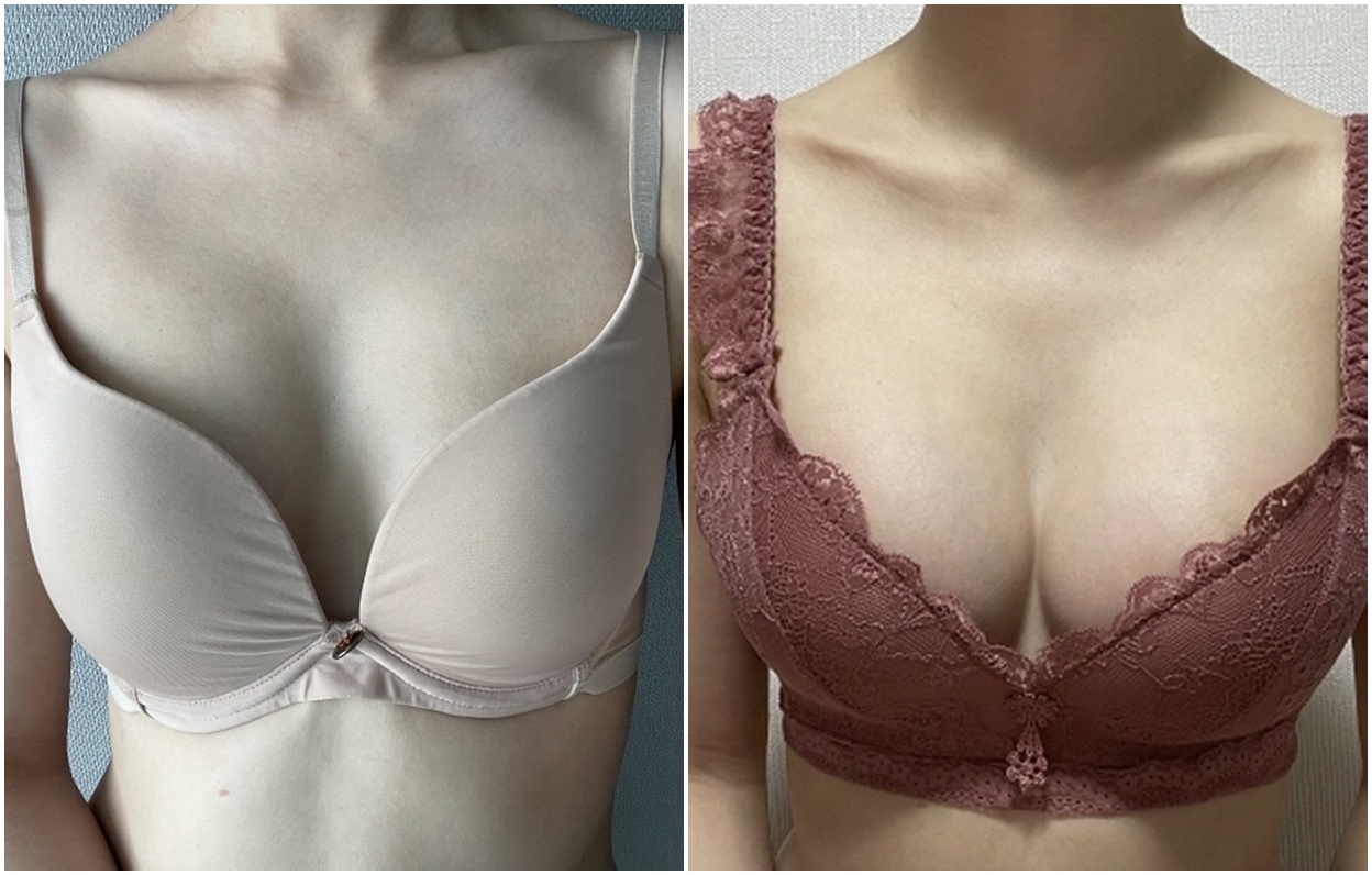 Hasil Breast Augmentation Di Badan Kurus