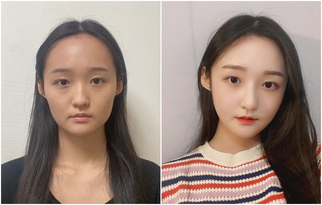 Review Operasi Kontur Wajah dan Hidung Dari Somsom!
