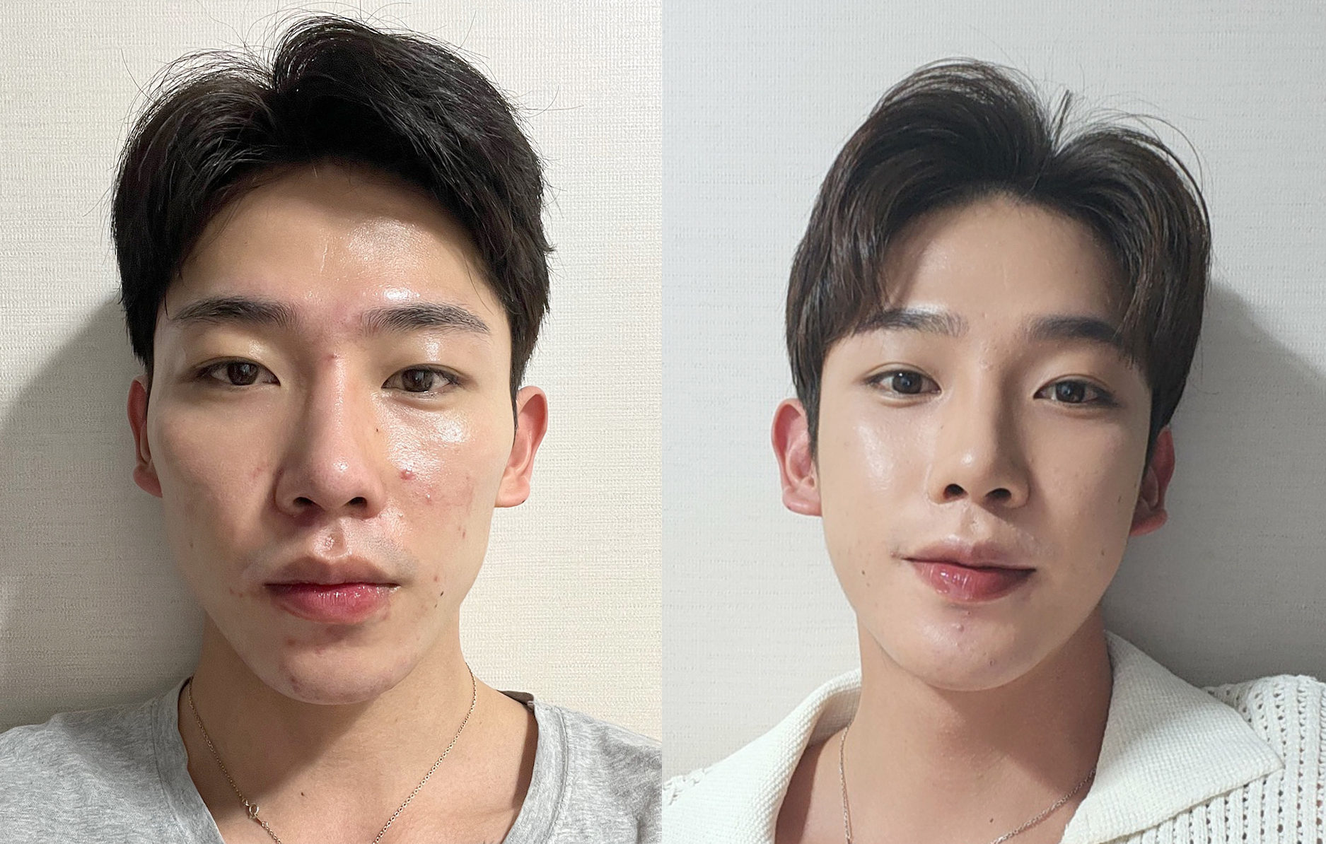 Jadi Cowok Cool Setelah Operasi Kontur Wajah!