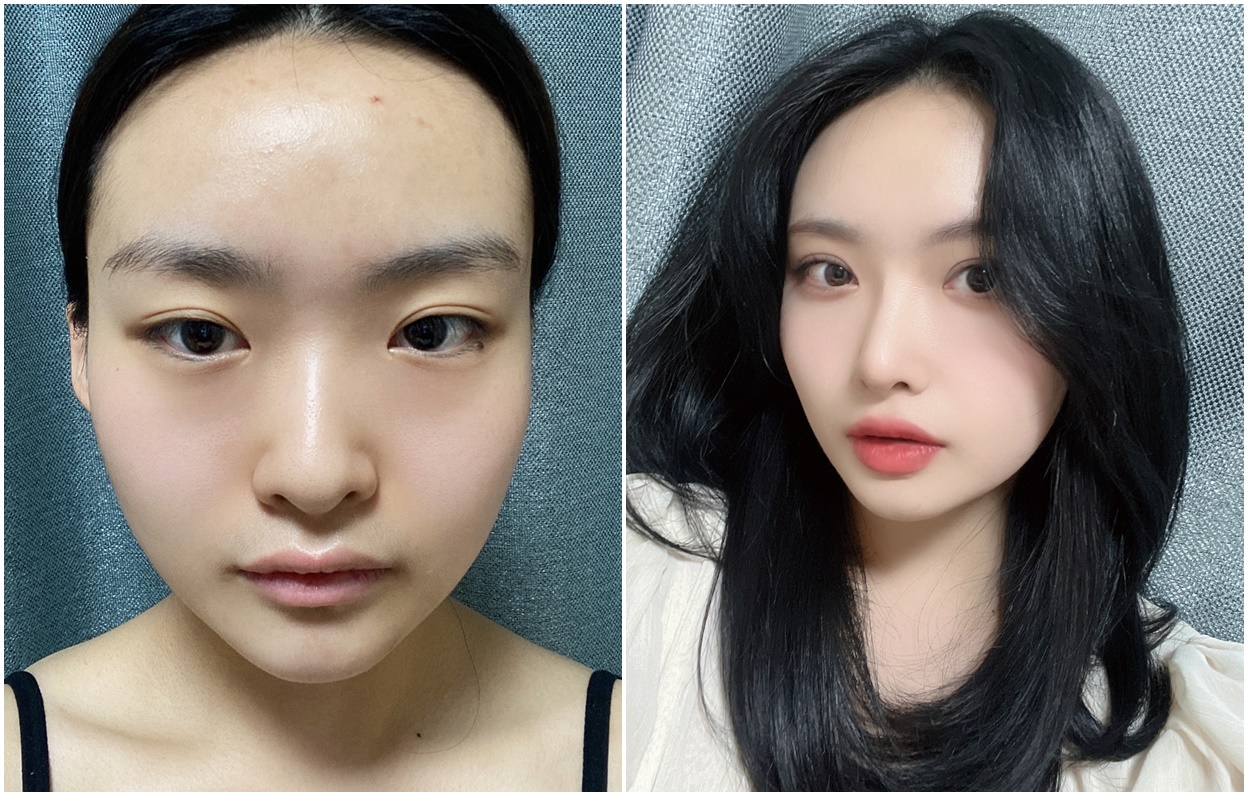 Revisi Operasi Lipatan Mata dan Hidung!