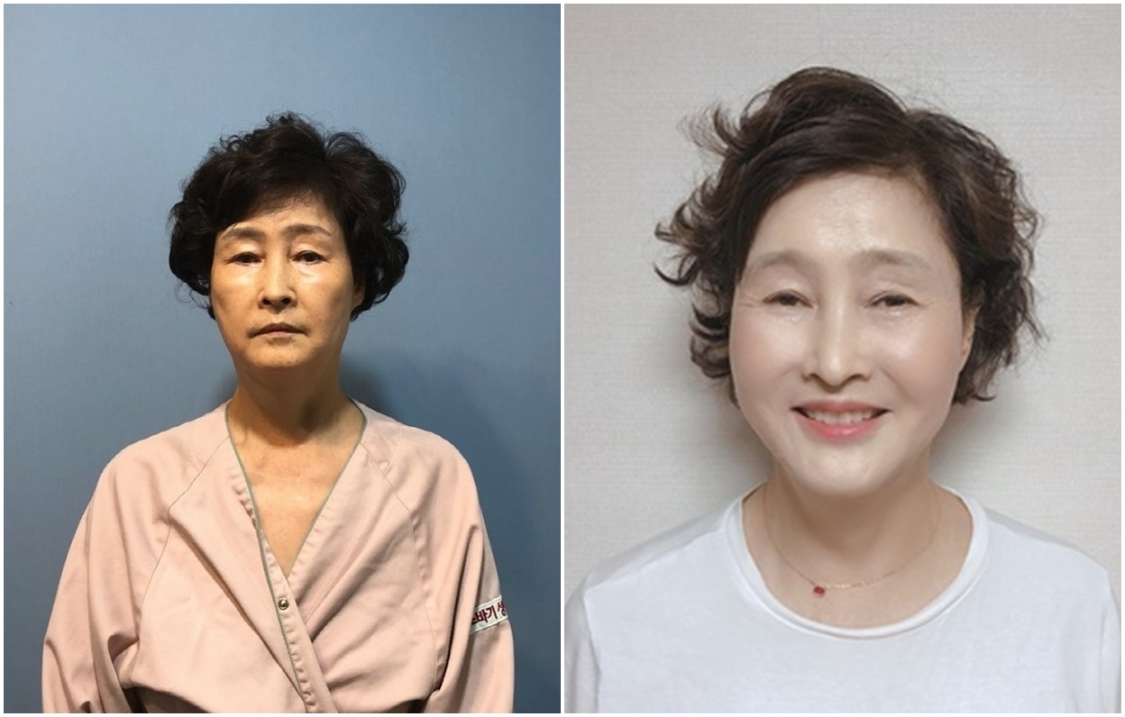 Menjalani Kehidupan Kedua Setelah Face Lifting!